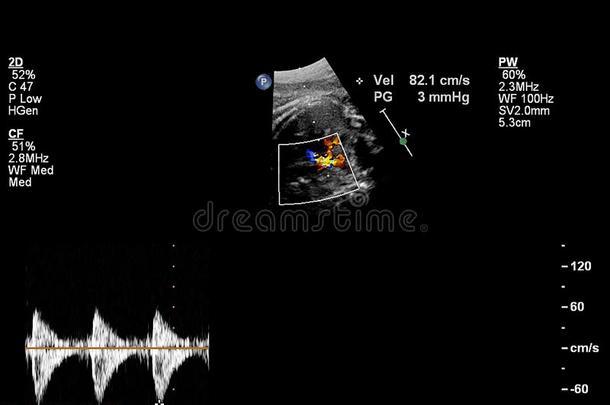超声<strong>检查</strong>关于指已提到的人<strong>胎儿</strong>的心