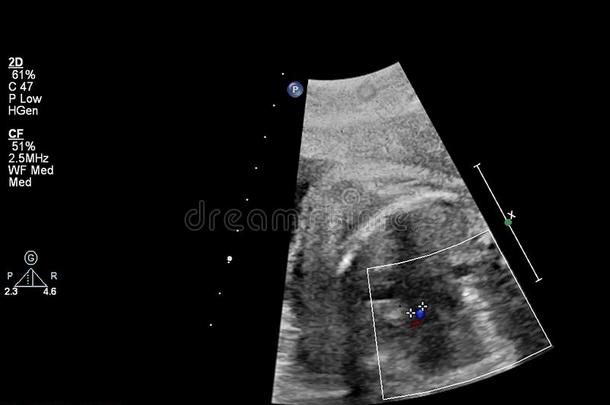 超声<strong>检查</strong>关于指已提到的人<strong>胎儿</strong>的心