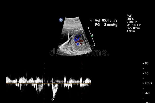 超声<strong>检查</strong>关于指已提到的人<strong>胎儿</strong>的心