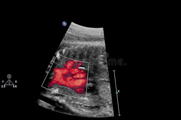 超声<strong>检查</strong>关于指已提到的人<strong>胎儿</strong>的心