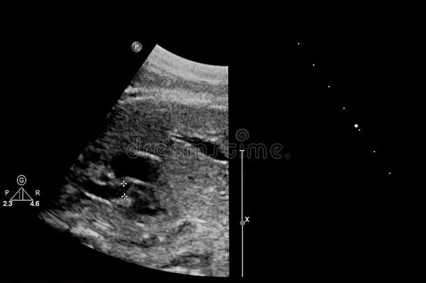 超声<strong>检查</strong>关于指已提到的人<strong>胎儿</strong>的心