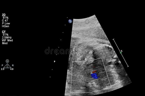 超声检查关于指已提到的人胎儿的心