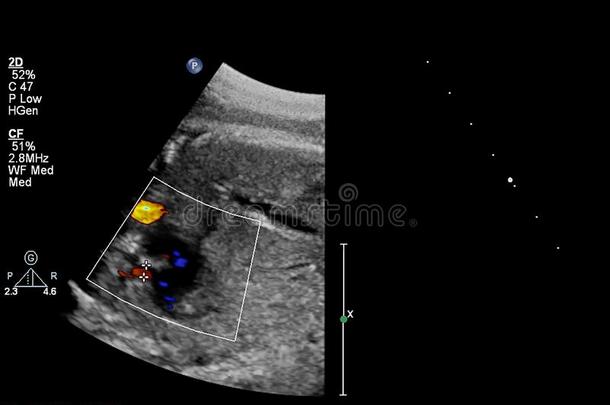 超声<strong>检查</strong>关于指已提到的人<strong>胎儿</strong>的心