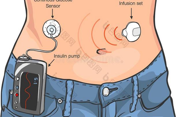 胰岛素泵为糖尿病患者矢量Ä°燃烧