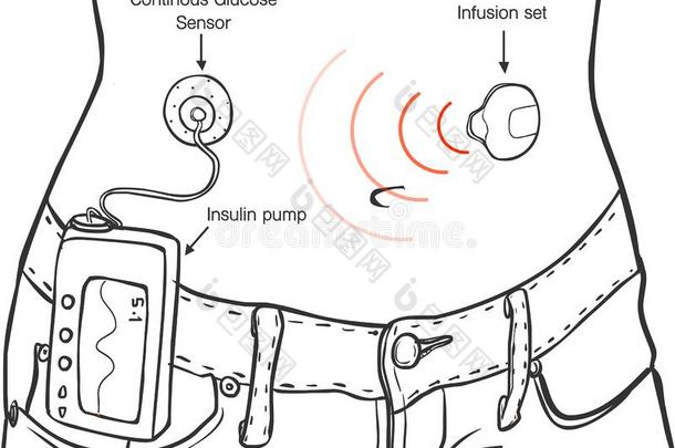 胰岛素泵为糖尿病患者矢量Ä°燃烧