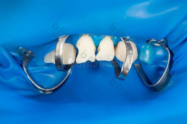 恢复关于人牙感动的在旁边龋齿和光敏聚合物