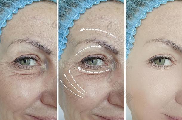 女人眼睛皱纹免职结果治疗修改复兴