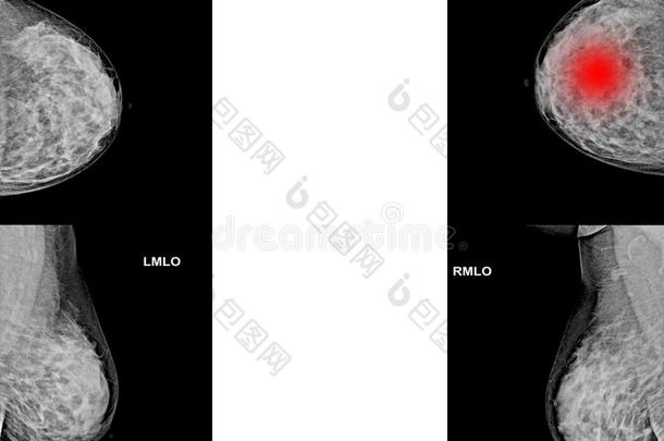 二者面收集关于乳房X线照片无线电成像为乳房歌曲