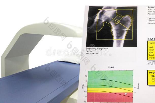 特殊的检查臀部骨头密度.结果骨质疏松症也blue蓝色