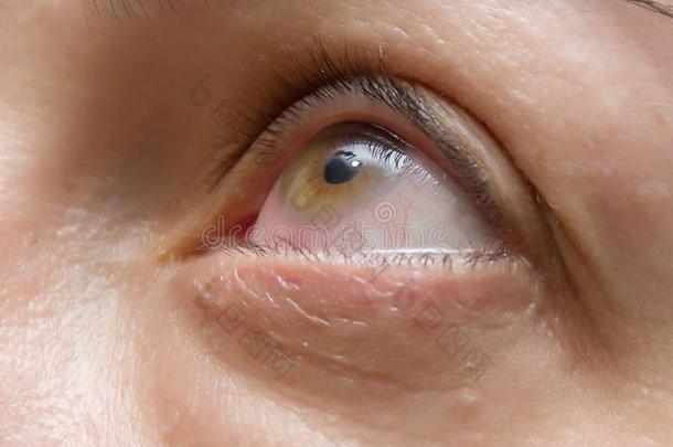 炎症和红关于指已提到的人<strong>眼睛</strong>,<strong>眼睛</strong>疾病和学生外科医生