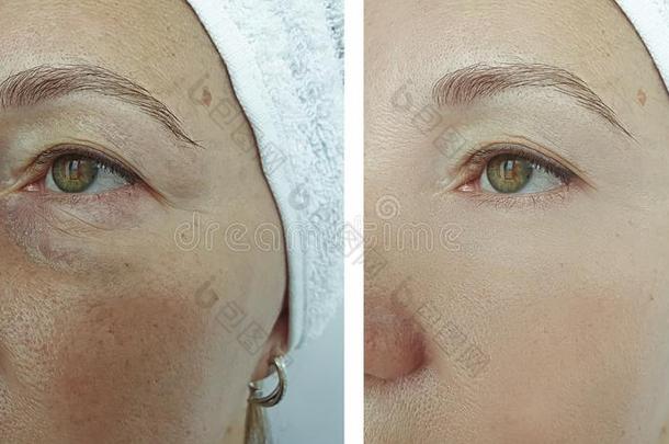 老的女人皱纹眼睛在之前和后的影响治疗