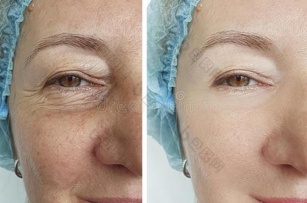 老的女人<strong>皱纹眼睛</strong>在之前和后的治疗
