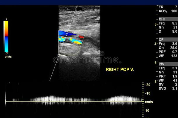 超声多普勒的关于腿弯部的Vienna维也纳为发现物深的静脉血栓