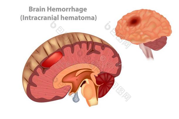 <strong>脑出血</strong>头颅内的血肿