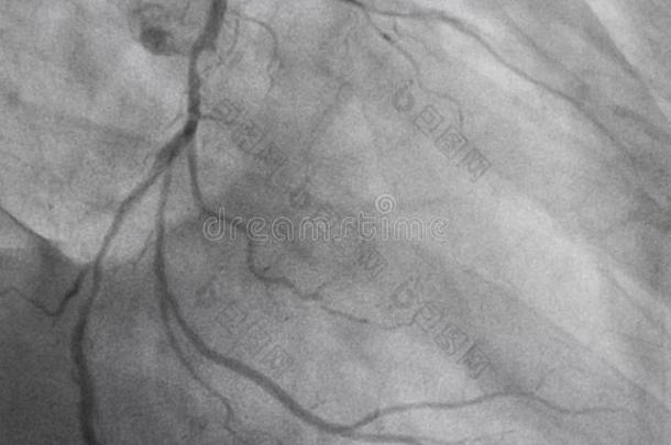 冠的<strong>血管</strong>造影法.左边的冠的<strong>血管</strong>造影法.