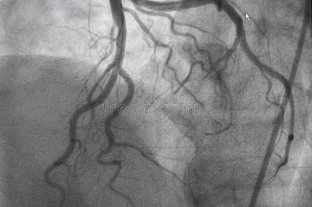 冠的血管造影法.左边的冠的血管造影法.