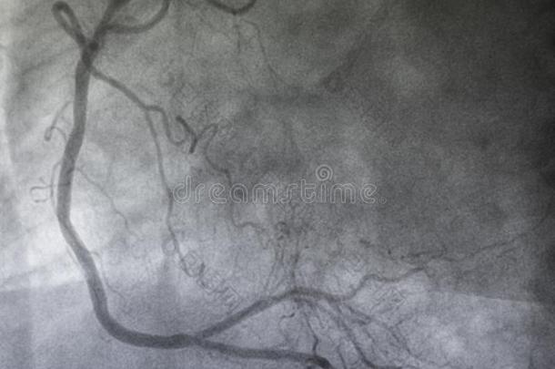 冠的血管造影法.立刻冠的血管造影法.