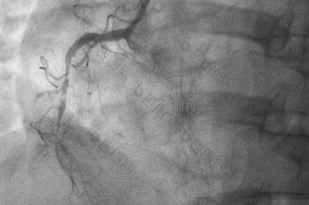冠的血管造影法.立刻冠的血管造影法.