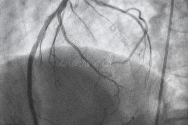 冠的血管造影法.左边的冠的血管造影法.