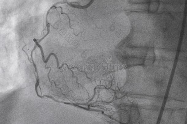 冠的血管造影法.立刻冠的血管造影法.