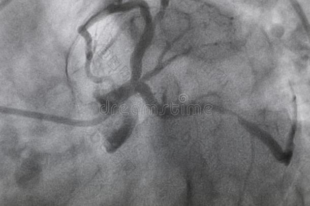 冠的<strong>血管</strong>造影法.左边的冠的<strong>血管</strong>造影法.