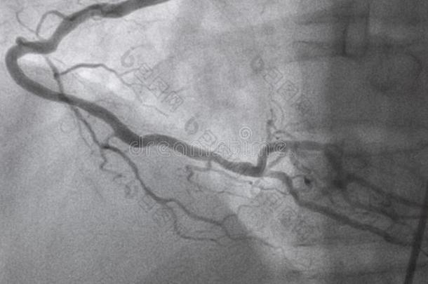 冠的血管造影法.立刻冠的血管造影法.
