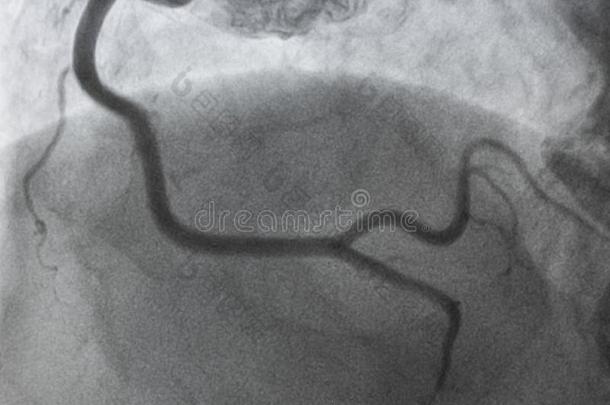 冠的血管造影法.立刻冠的血管造影法.