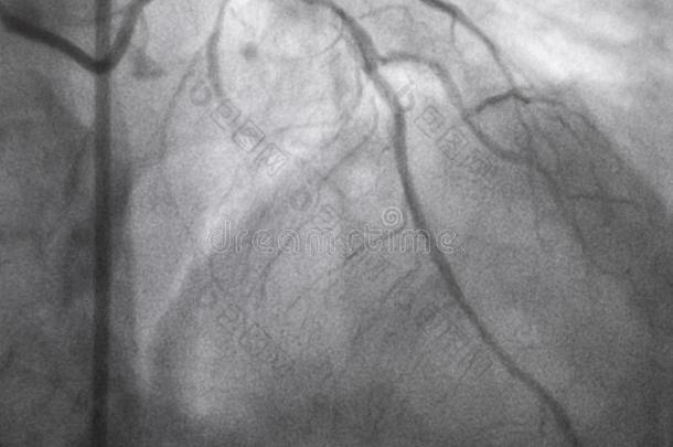 冠的血管造影法.左边的冠的血管造影法.