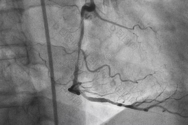冠的血管造影法.立刻冠的血管造影法.