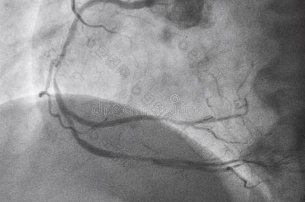 冠的血管造影法.立刻冠的血管造影法.