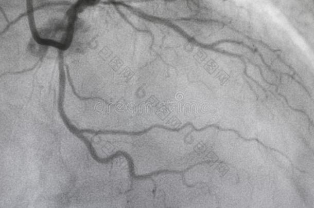 冠的血管<strong>造影</strong>法.左边的冠的血管<strong>造影</strong>法.
