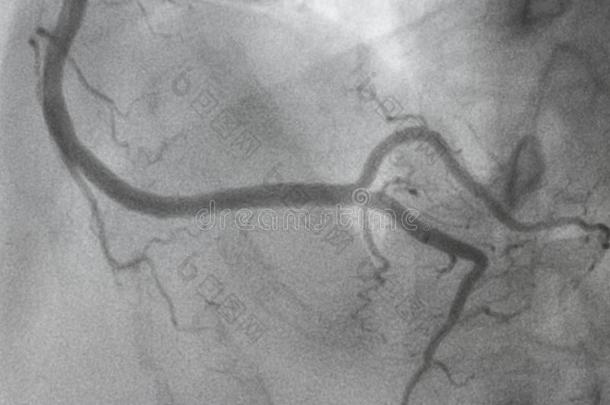 冠的血管造影法.立刻冠的血管造影法.
