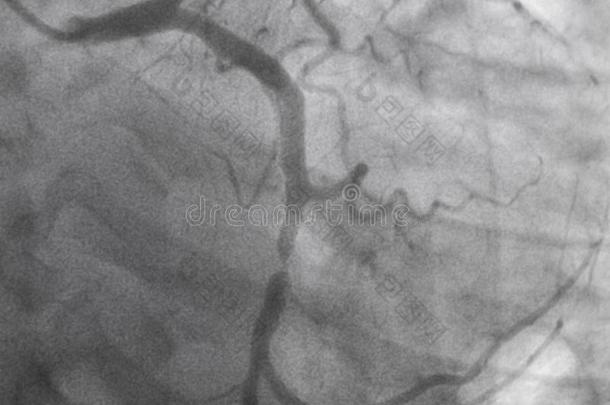 冠的<strong>血管</strong>造影法.左边的冠的<strong>血管</strong>造影法.