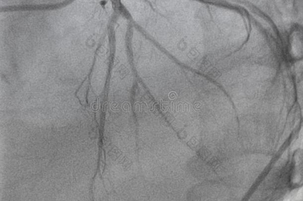 冠的血管<strong>造影</strong>法.左边的冠的血管<strong>造影</strong>法.