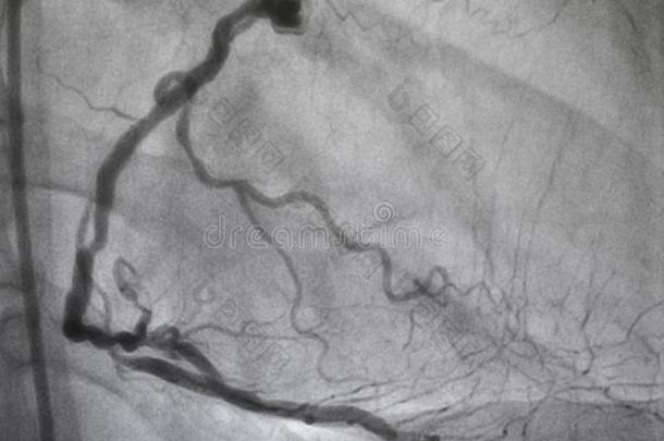 冠的血管造影法.立刻冠的血管造影法.