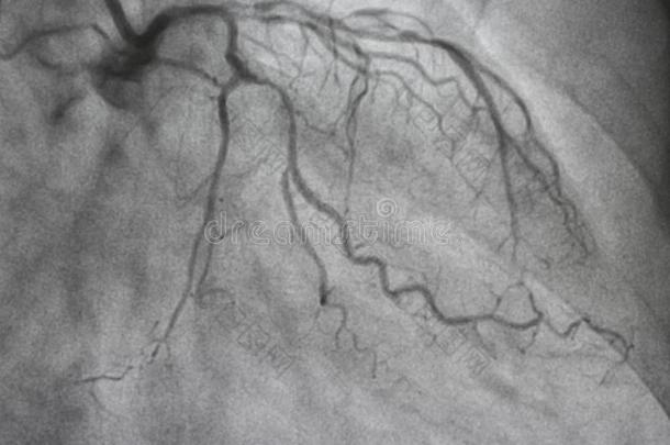 冠的血管造影法.左边的冠的血管造影法.