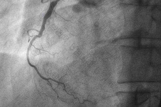 冠的血管造影法.立刻冠的血管造影法.