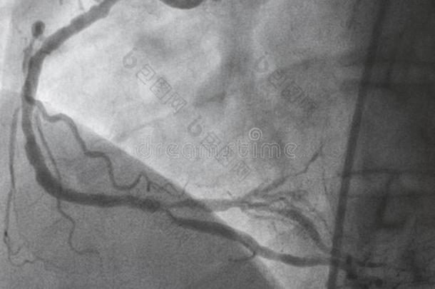 冠的血管<strong>造影</strong>法.立刻冠的血管<strong>造影</strong>法.