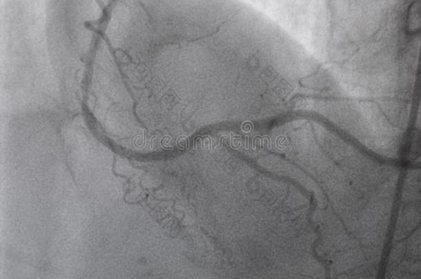 冠的血管<strong>造影</strong>法.立刻冠的血管<strong>造影</strong>法.