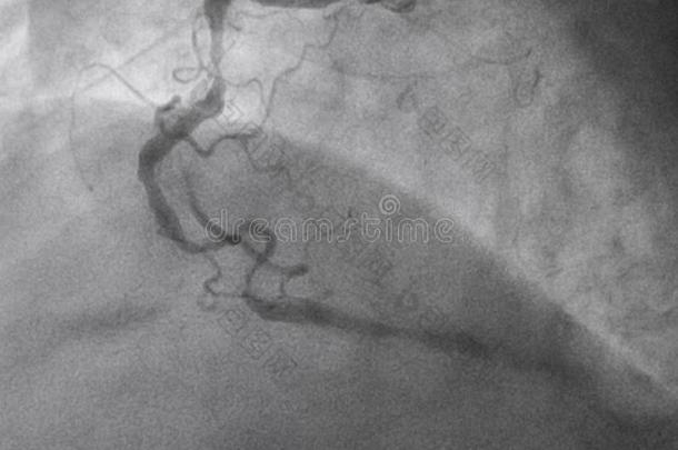 冠的血管造影法.立刻冠的血管造影法.
