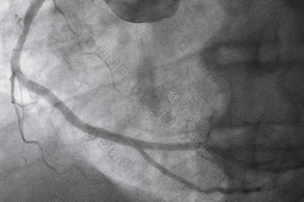 冠的血管造影法.立刻冠的血管造影法.