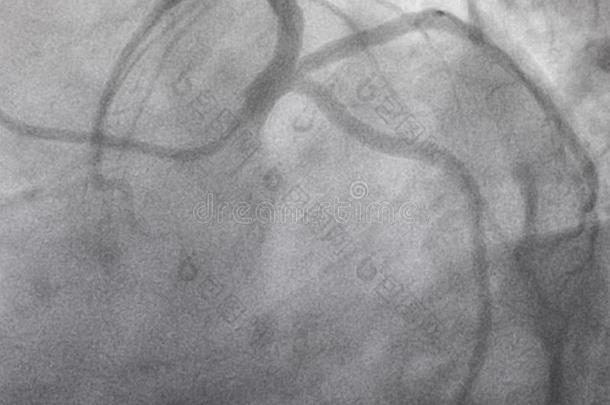 冠的<strong>血管</strong>造影法.左边的冠的<strong>血管</strong>造影法.