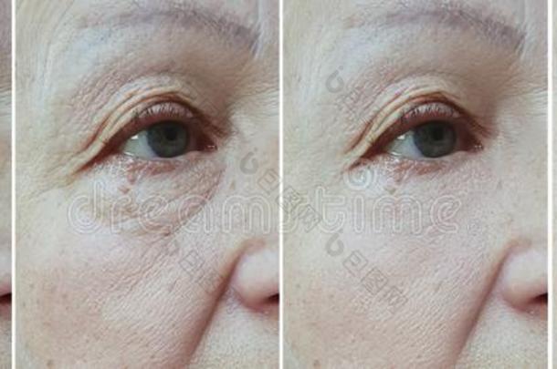 老的女人皱纹眼睛在之前和后的结果治疗