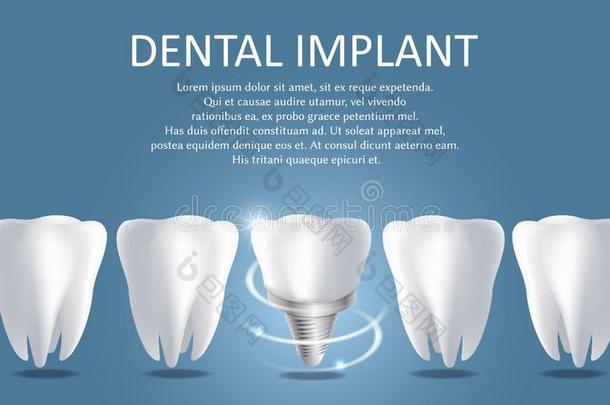 <strong>牙齿的</strong>移植物矢量医学<strong>的海报</strong>横幅样板
