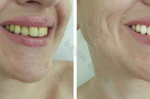 女人牙在之前后的变白卫生