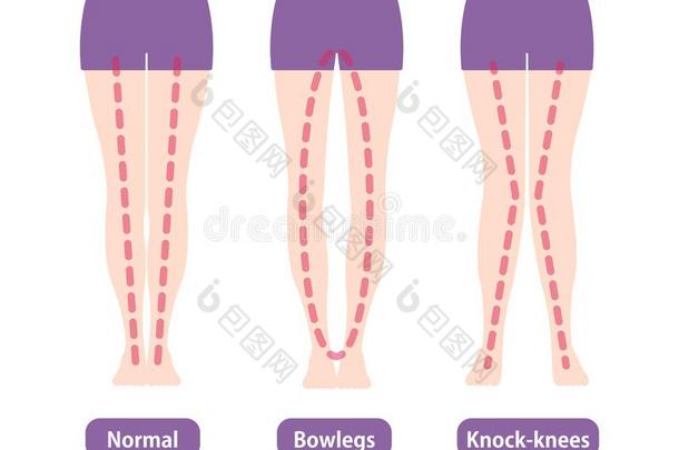 差别类型关于木头支架角和膝矢量说明.
