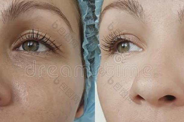 女人眼睛皱纹在之前和后的治疗美容学