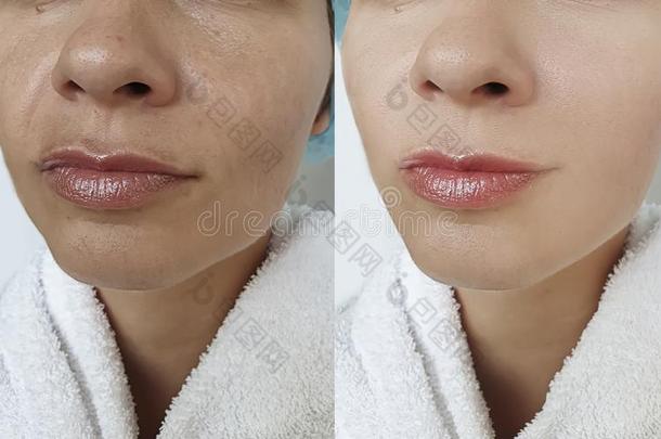 女人皱纹吸水在之前和后的治疗美容学