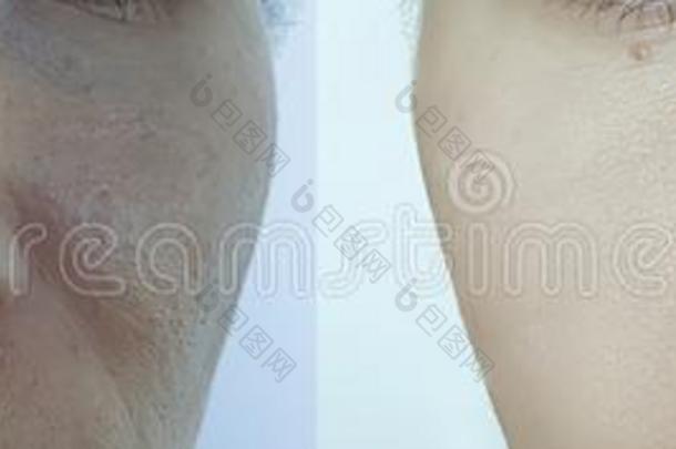女人皱纹<strong>吸水</strong>治疗问题在之前和后的治疗