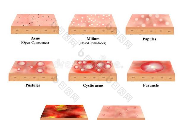 类型关于痤疮皮炎症.丘疹,沸腾,粟粒疹,closure关闭
